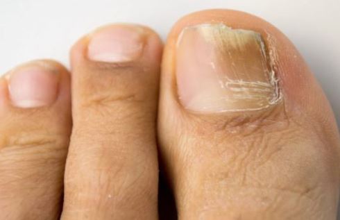 3 cách giúp bạn giải quyết tình trạng nấm móng