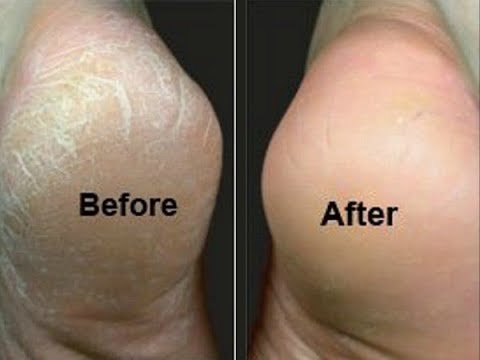 2 cách trị nứt gót chân ai cũng làm được