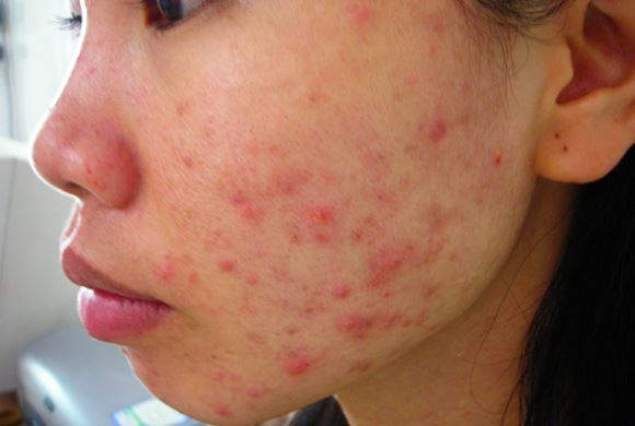 Thói quen khiến bạn bị hủy hoại nhan sắc