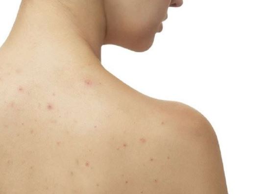 Mụn ở lưng trị thế nào cho đúng?