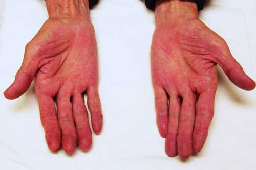 Những dấu hiệu từ bàn tay, bàn chân cảnh báo gan của bạn 'có vấn đề', cần đi khám ngay