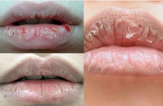 Chữa môi khô không khó như bạn nghĩ đâu nhé