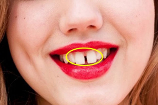 Nhìn tướng răng biết tương lai thành công hay nghèo khổ: Người răng thưa đừng mong tích lũy