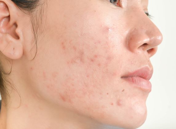 Hết thâm mụn chỉ bằng cách dùng nha đam