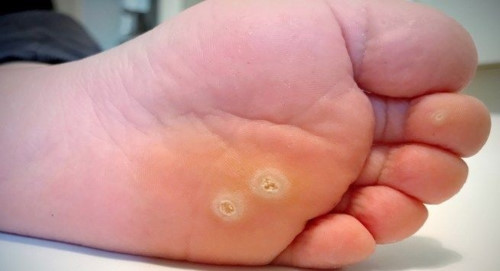 Dùng tỏi bạn có thể trị mụn cóc tại nhà