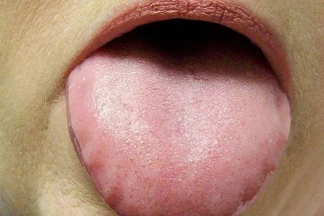 Lưỡi bỗng xuất hiện đốm trắng là dấu hiệu của bệnh gì? Trường hợp đặc biệt có thể là bệnh ung thư nguy hiểm