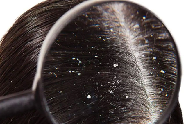 5 mẹo đánh bay gàu tự nhiên tại nhà