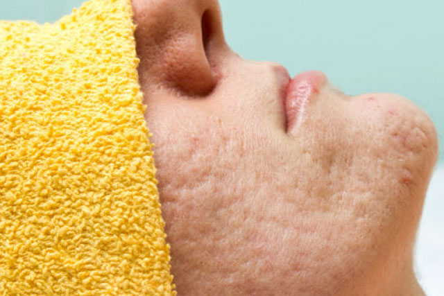 Những nguyên nhân chính gây tình trạng lỗ chân lông to