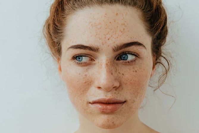 9 mẹo đối phó với tàn nhang trên mặt