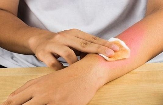 Cách chữa vết bỏng bạn phải ghi nhớ luôn hôm nay
