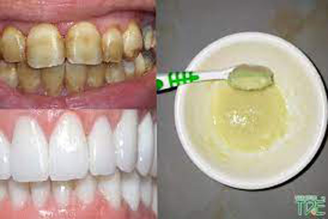 Răng ố vàng lâu năm cứ lấy thứ này chà lên, 5 phút sau bạn sẽ thấy kết quả bất ngờ