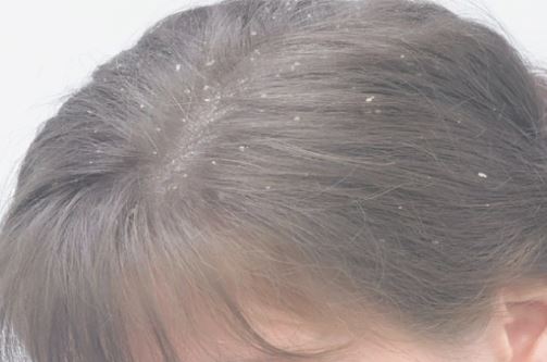 Trị gàu tận gốc tại nhà có thể bạn chưa biết