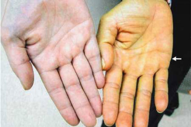 Cơ thể đau 4 vùng này chứng tỏ bệnh gan đã đi vào giai đoạn nặng, có 1 cũng nên đi khám