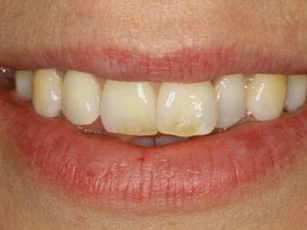 3 cách làm trắng răng bạn phải biết