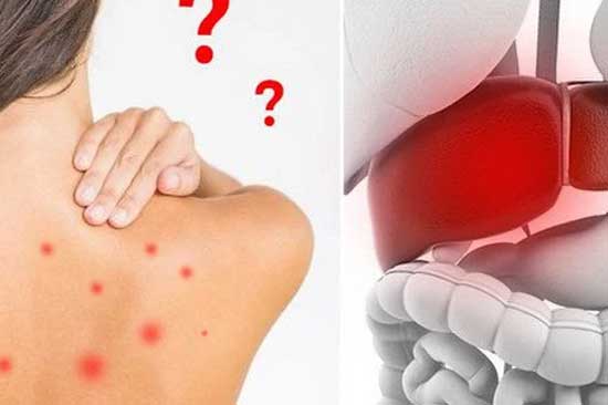 Những dấu hiệu cảnh báo bệnh gan mà bạn không thể bỏ qua, nhất là số 1