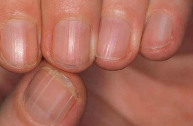 Móng tay có những dấu hiệu này báo hiệu nội tạng mắc bệnh nguy hiểm