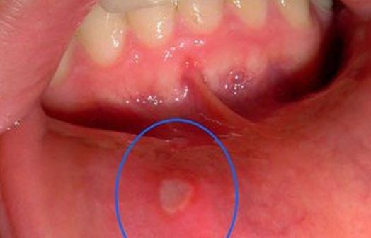 Trị nhiệt miệng thần tốc tại nhà bạn phải biết