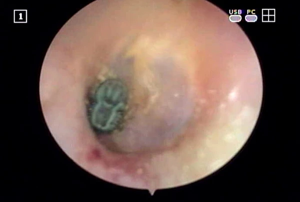 Qua nội soi, các bác sĩ Thiện Nhân Đà Nẵng phát hiện con bọ chét nằm trong ống tai chị 