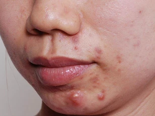 Chế độ dinh dưỡng cho người bị mụn trứng cá