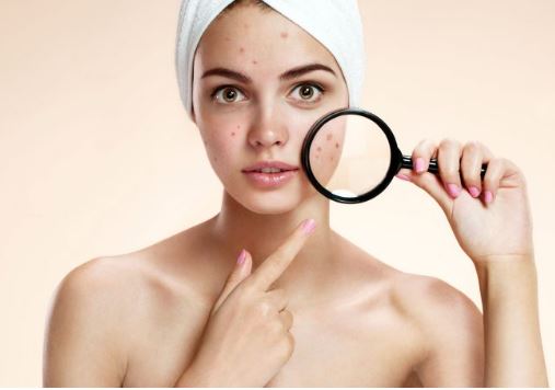 5 lý do khiến da bạn bị mụn quanh năm