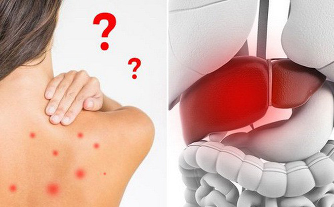Dấu hiệu lạ xuất hiện trên da cảnh báo gan đang không khỏe, cần nhanh chân đi kiểm tra gấp