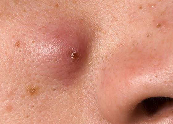 3 cách trị mụn nhọt bạn cần nhớ