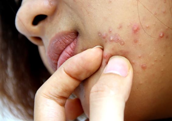 Mụn mọc ngày càng nhiều vì những nguyên nhân không tưởng