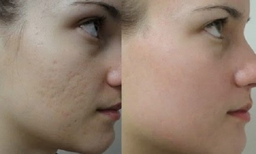 2 cách giúp trị sẹo tại nhà đơn giản nhất