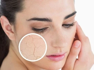 Thấy 4 dấu hiệu này bạn cần bổ sung nước cho da ngay