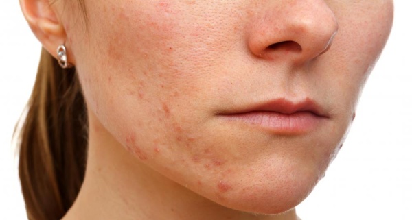 Cách trị mụn cám từ thiên nhiên bạn phải nhớ