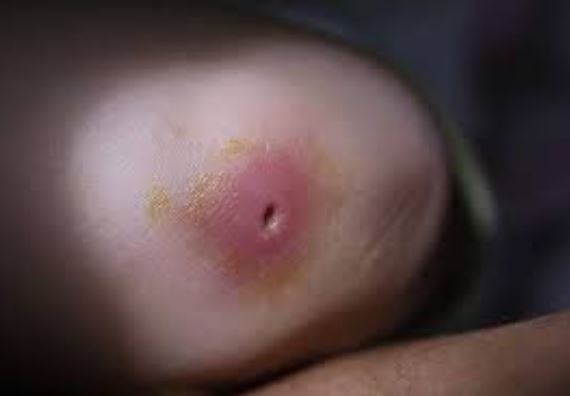 Chữa mụn nhọt bằng phương pháp đơn giản