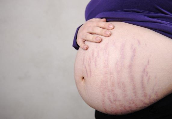Rạn da khi mang bầu và những điều bạn phải biết