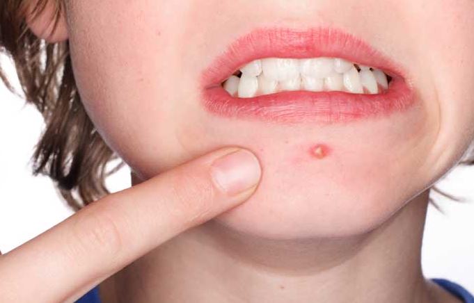 3 cách giúp bạn trị mụn bọc tại nhà hiệu quả