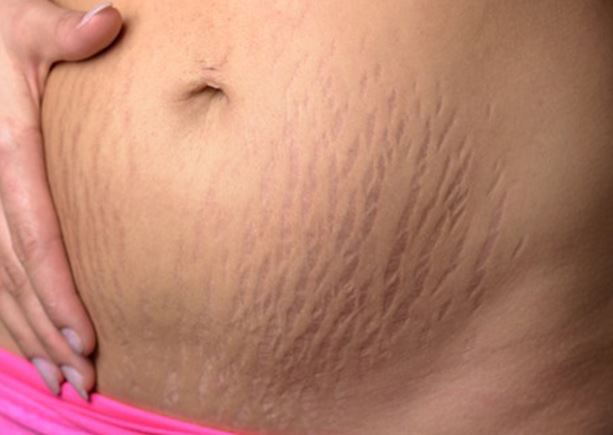 Bạn có thể trị rạn da hiệu quả bằng cách dùng dầu dừa