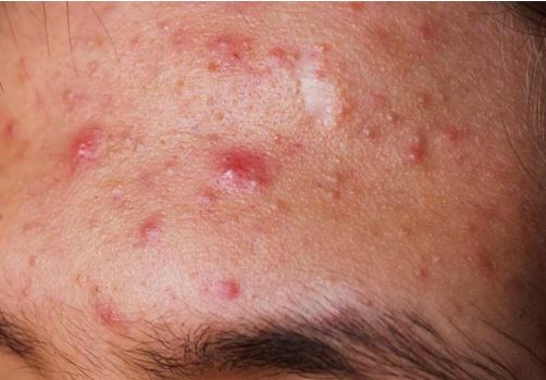 Biết điều này bạn sẽ không lo mụn trên trán