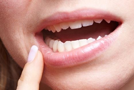 Dấu hiệu ung thư miệng bạn cần đi khám ngay