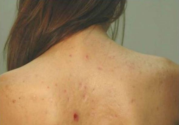 3 cách trị mụn ở lưng có thể bạn chưa biết