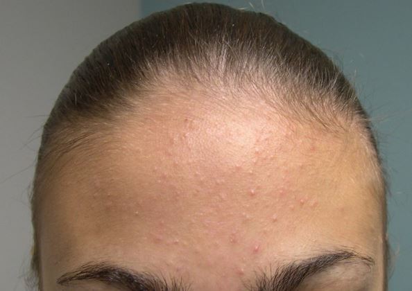 Cách trị mụn ẩn dưới da vô cùng hiệu quả