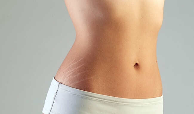 Mách bạn cách chữa rạn da hiệu quả ở tuổi dậy thì