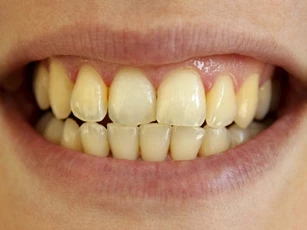Bí quyết giúp răng không bị tình trạng ố vàng
