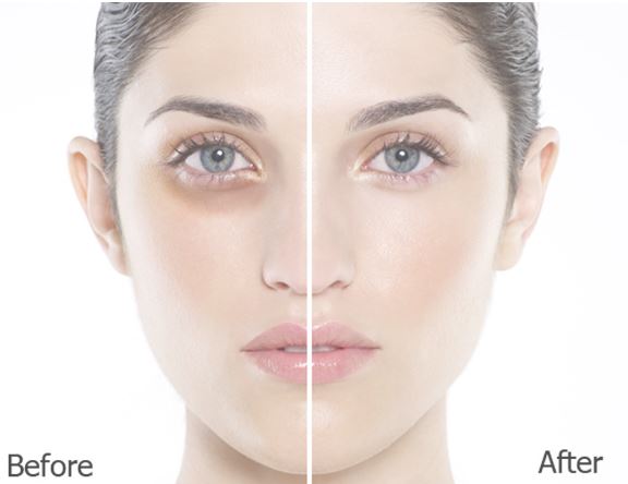 Mắt như 'gấu trúc' cũng hết thâm chỉ với phương pháp này