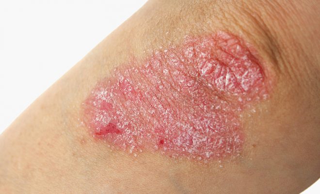 Những điều bạn bắt buộc phải biết về bệnh vảy nến