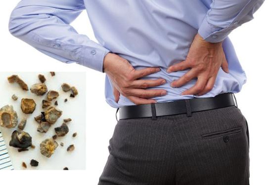 3 điều phải biết để tránh sỏi thận