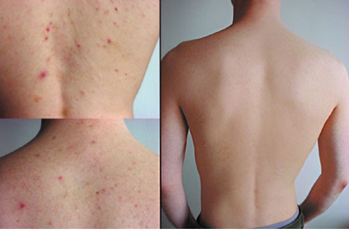 4 điều cần ghi nhớ để có thể hết mụn ở lưng