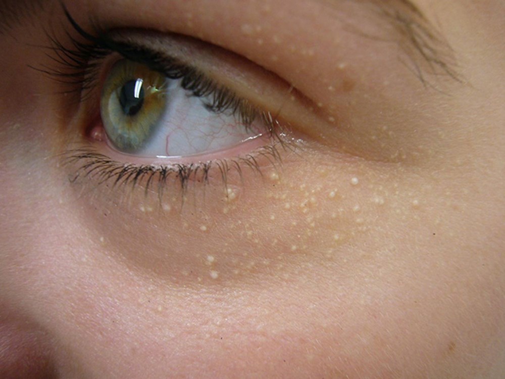 3 công thức từ dân gian giúp bạn trị mụn thịt cực nhanh