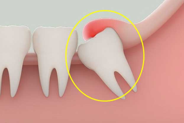 Vì sao hay mọc "ngu" nhưng vẫn gọi là răng khôn?