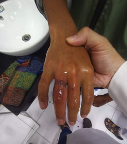 Cần Thơ: Suýt bị hoại tử ngón tay vì mua nhẫn trên mạng về đeo