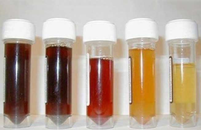 Nhìn vào nước tiểu biết tình trạng sức khỏe, màu thứ 3 cực kỳ nguy hiểm