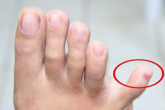 Muốn biết thận có khỏe mạnh hay không, cứ nhìn 4 đặc điểm ở bàn chân là rõ