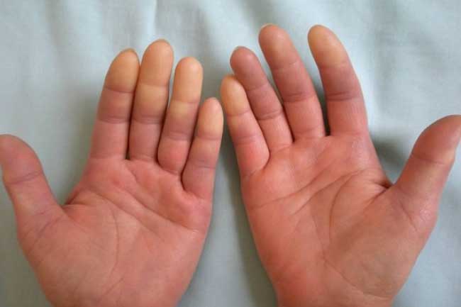 7 dấu hiệu trên da báo hiệu bệnh tiểu đường, thấy nổi mụn bất thường hãy cảnh giác